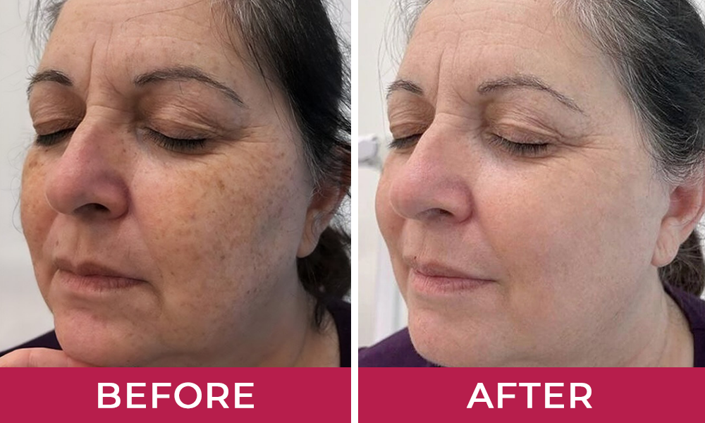 HydraLyft Collagen Face Mask Customer 1