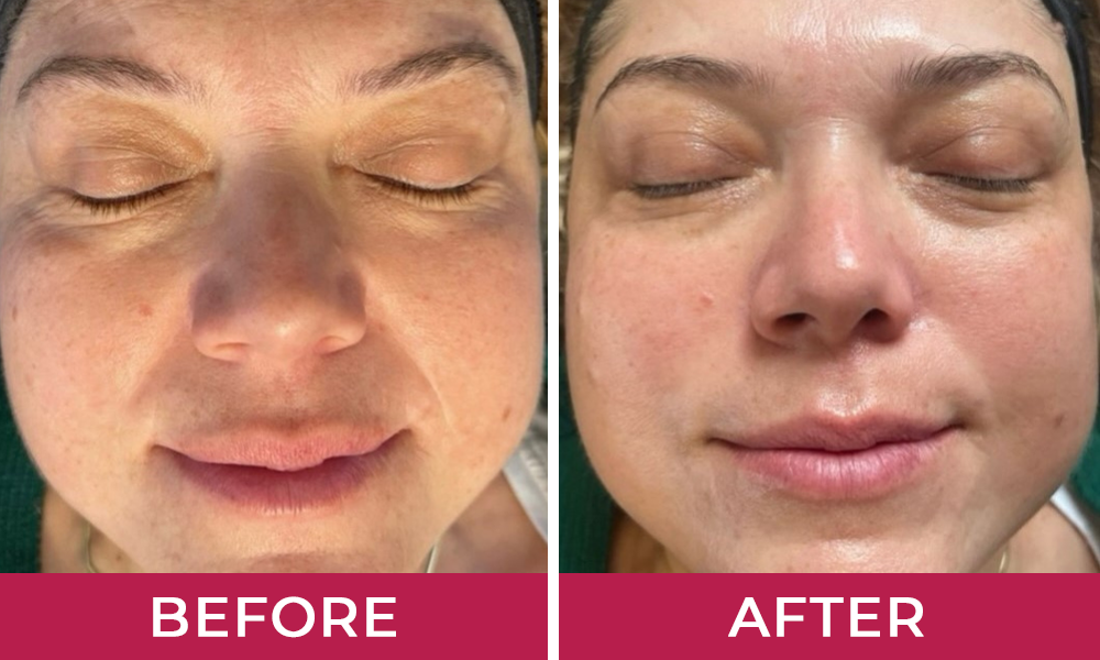HydraLyft Collagen Face Mask Customer 2
