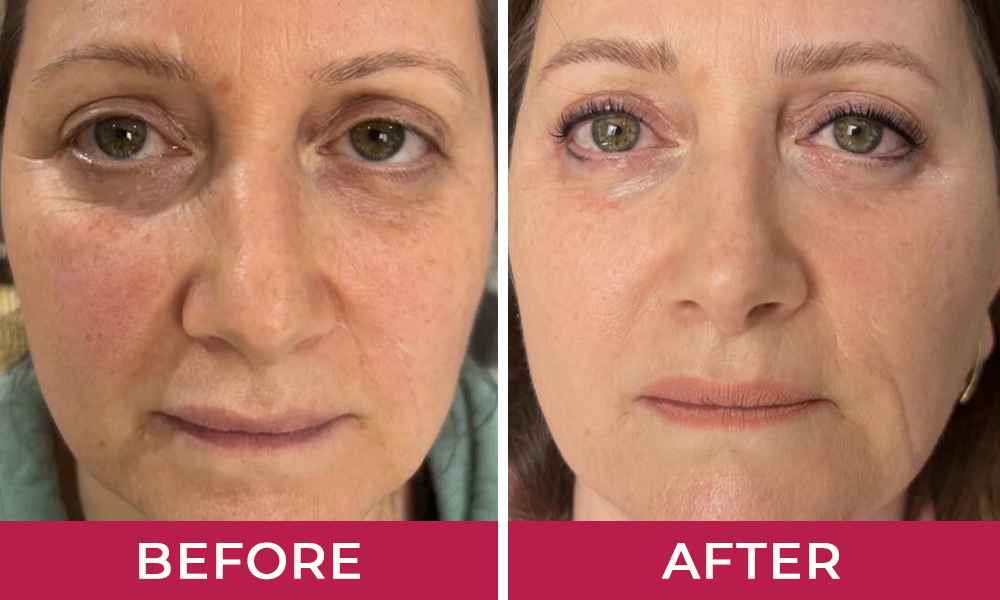HydraLyft Collagen Face Mask Customer 3