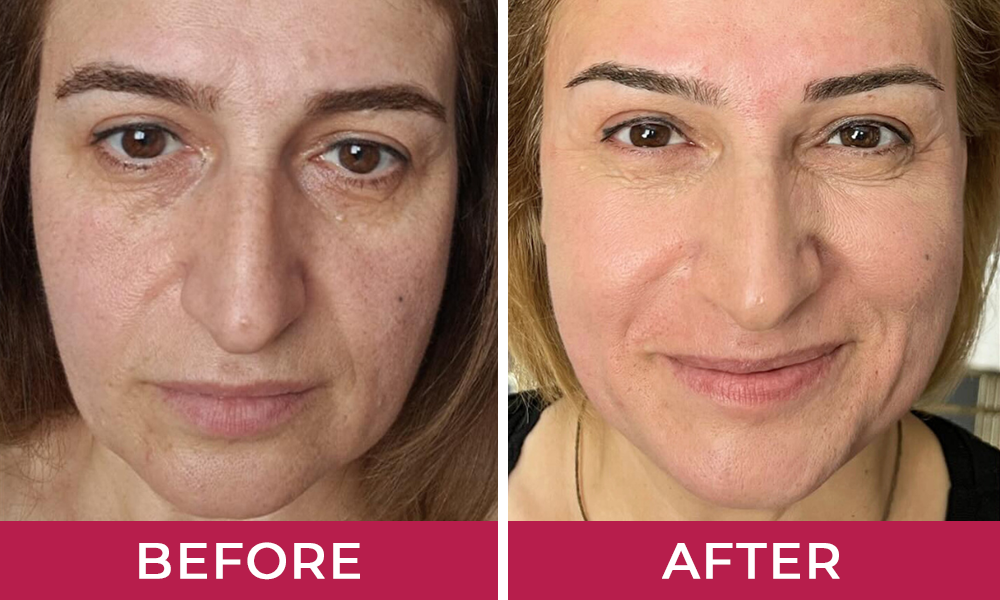 HydraLyft Collagen Face Mask Customer 4