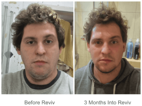 Reviv Mouth Guard Before and After
